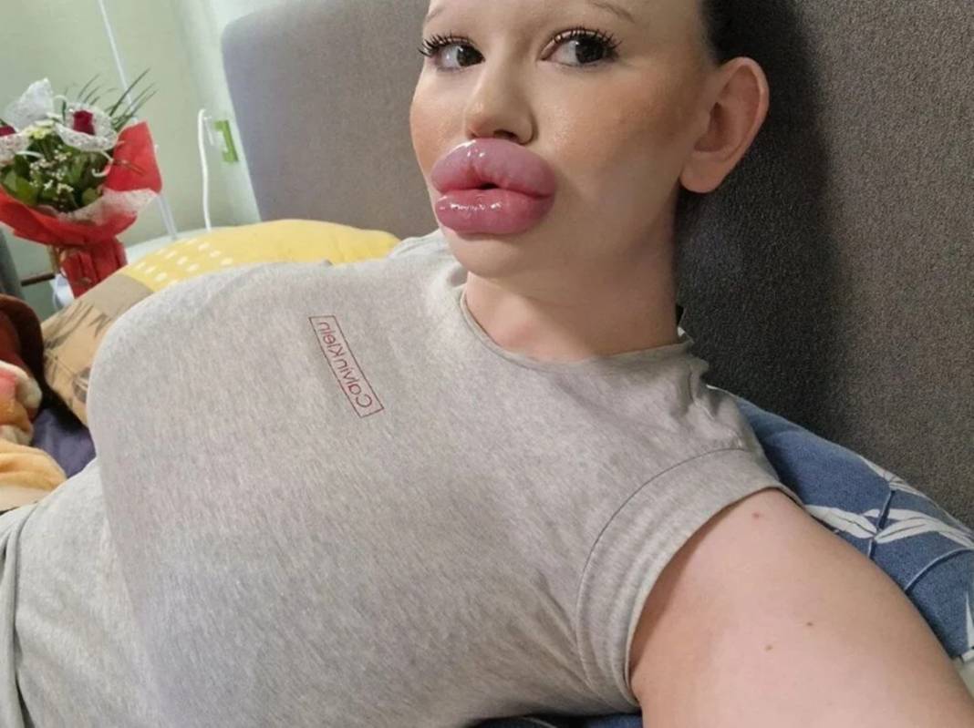 Dudak estetiğine harcadığı para 'dudak' uçuklattı 2